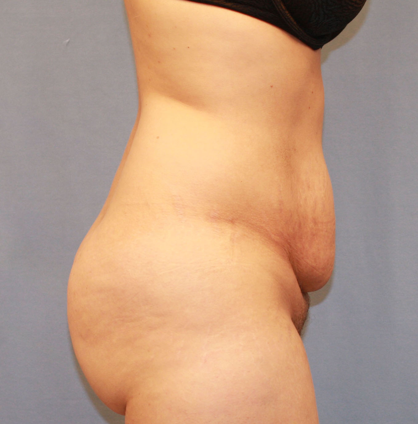 Before Image: Tummy Tuck - right-side