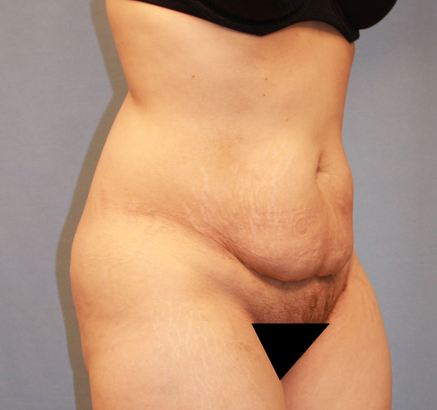 Before Image: Tummy Tuck - right-front-oblique