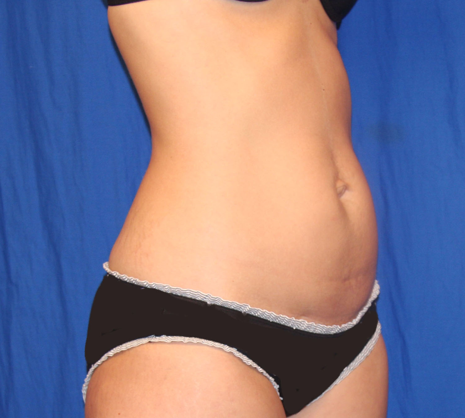 Before Image: Tummy Tuck - right-front-oblique