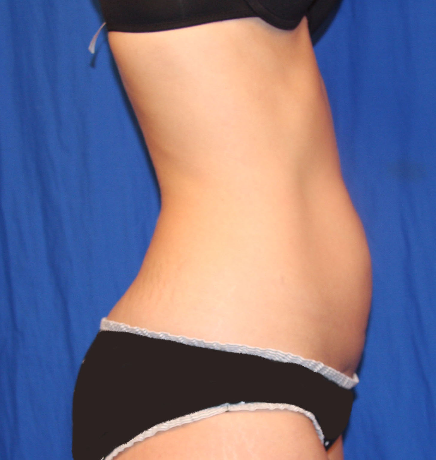Before Image: Tummy Tuck - right-side