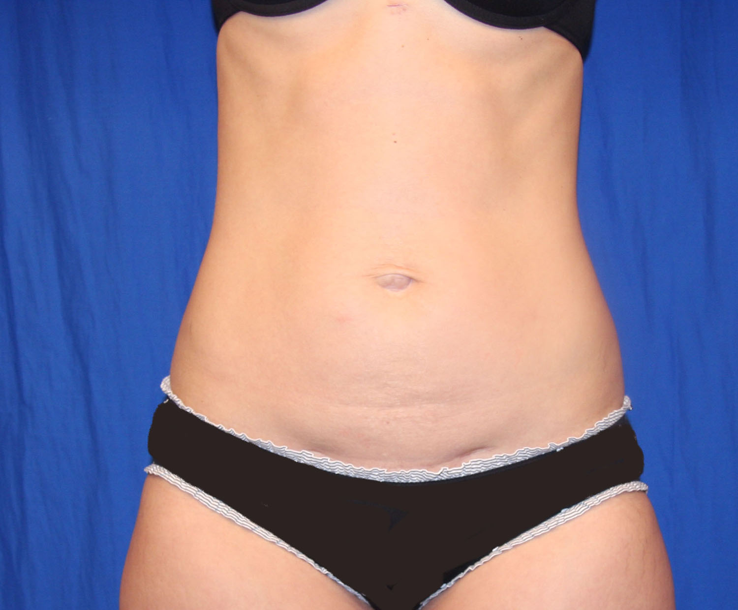 Before Image: Tummy Tuck - front