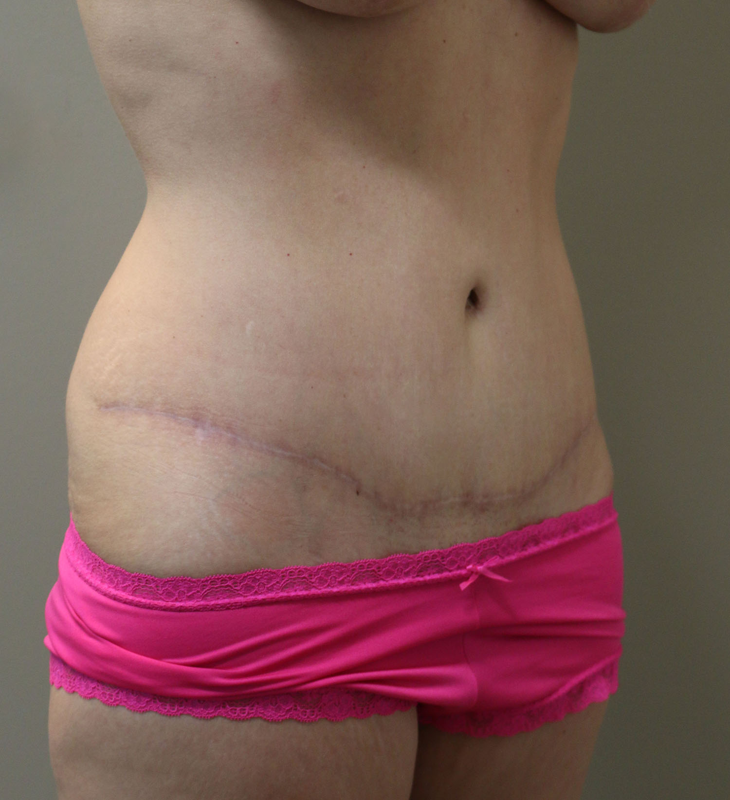 After Image: Tummy Tuck - right-front-oblique