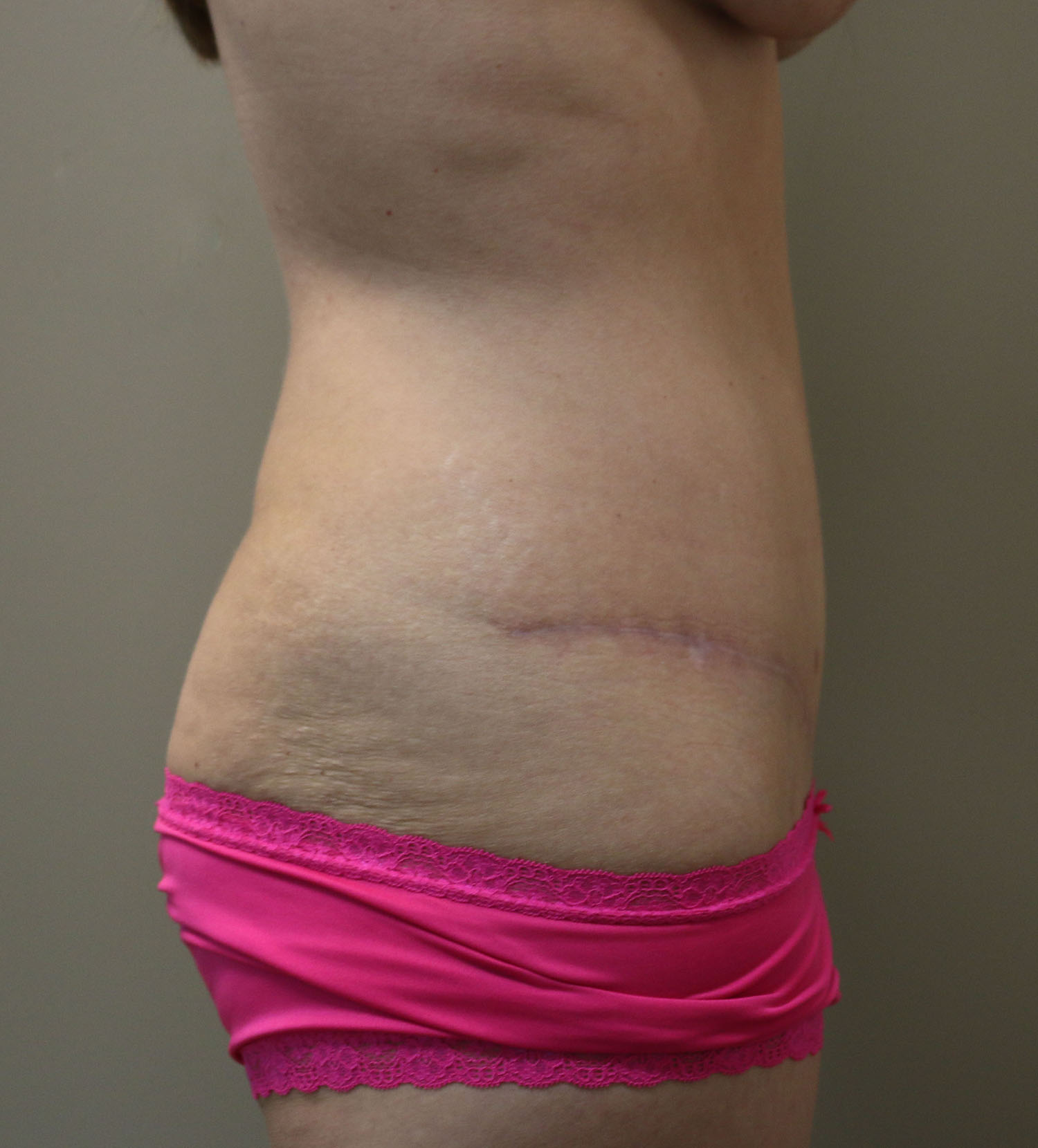 After Image: Tummy Tuck - right-side