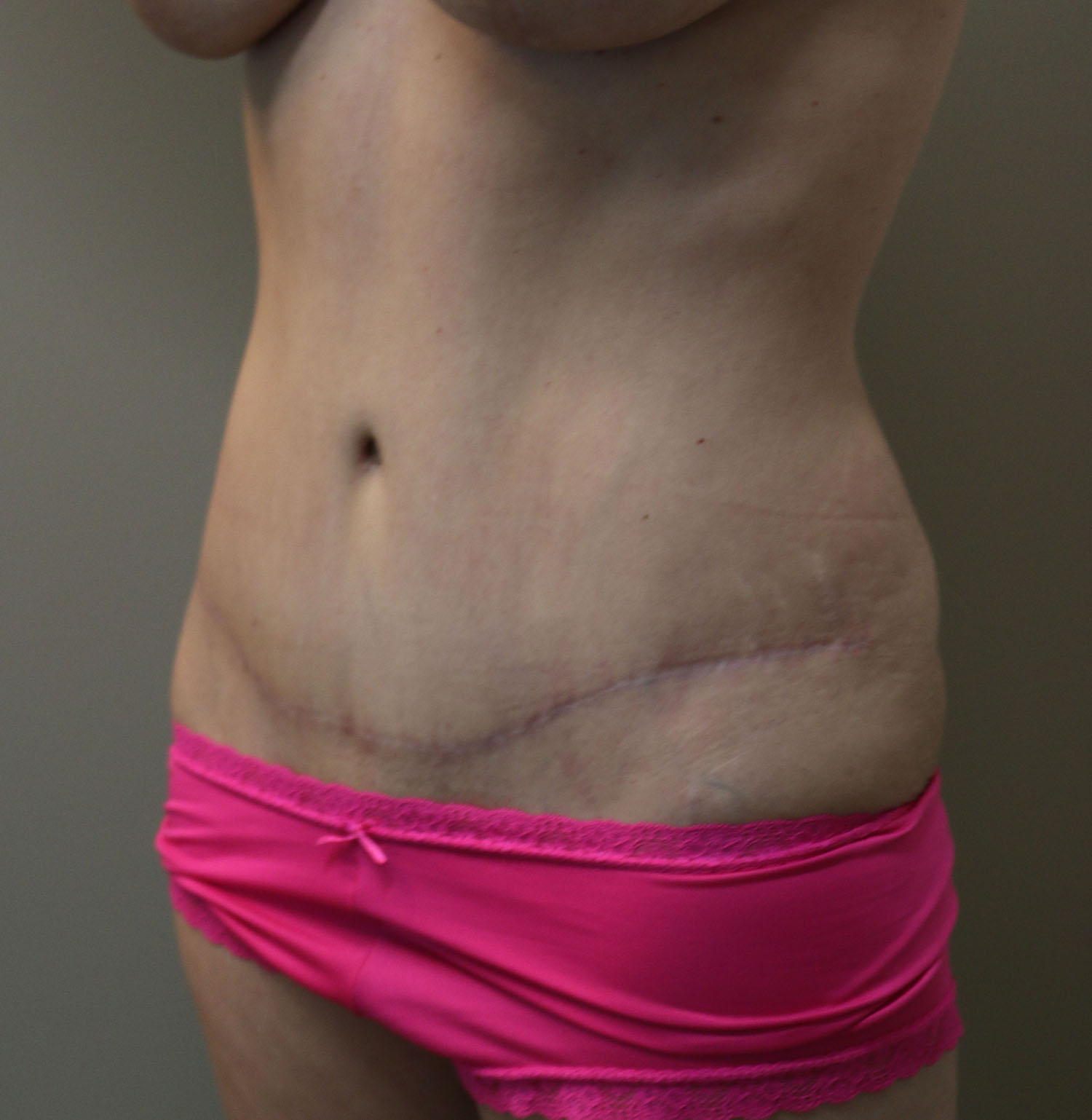 After Image: Tummy Tuck - left-front-oblique