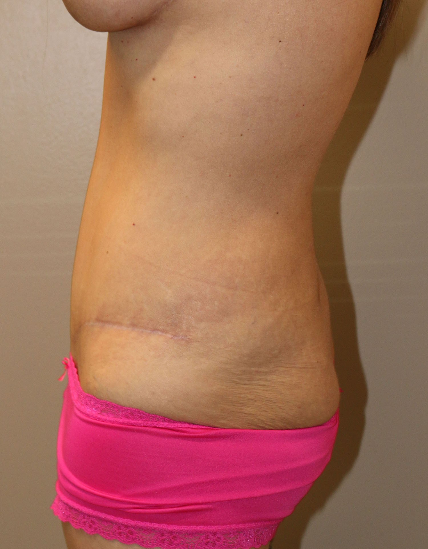 After Image: Tummy Tuck - left-side