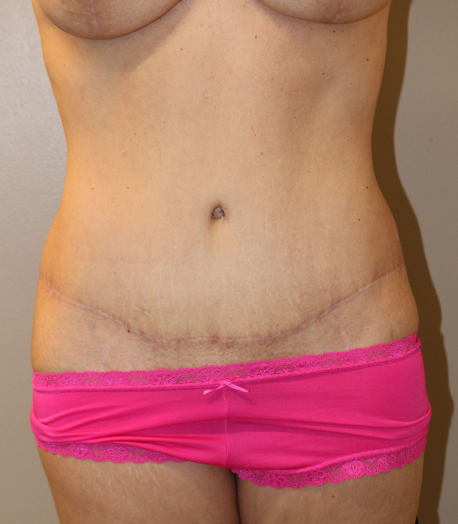 After Image: Tummy Tuck - front
