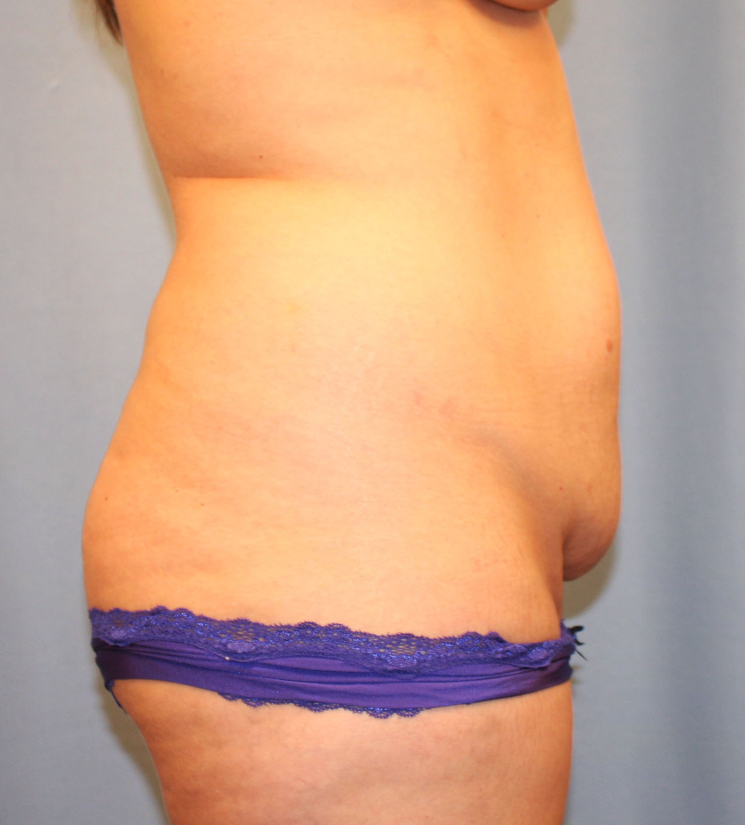 Before Image: Tummy Tuck - right-side