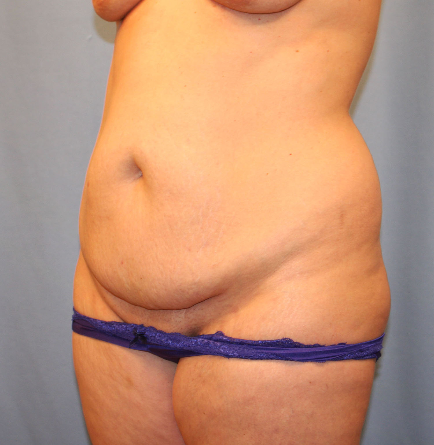 Before Image: Tummy Tuck - left-front-oblique
