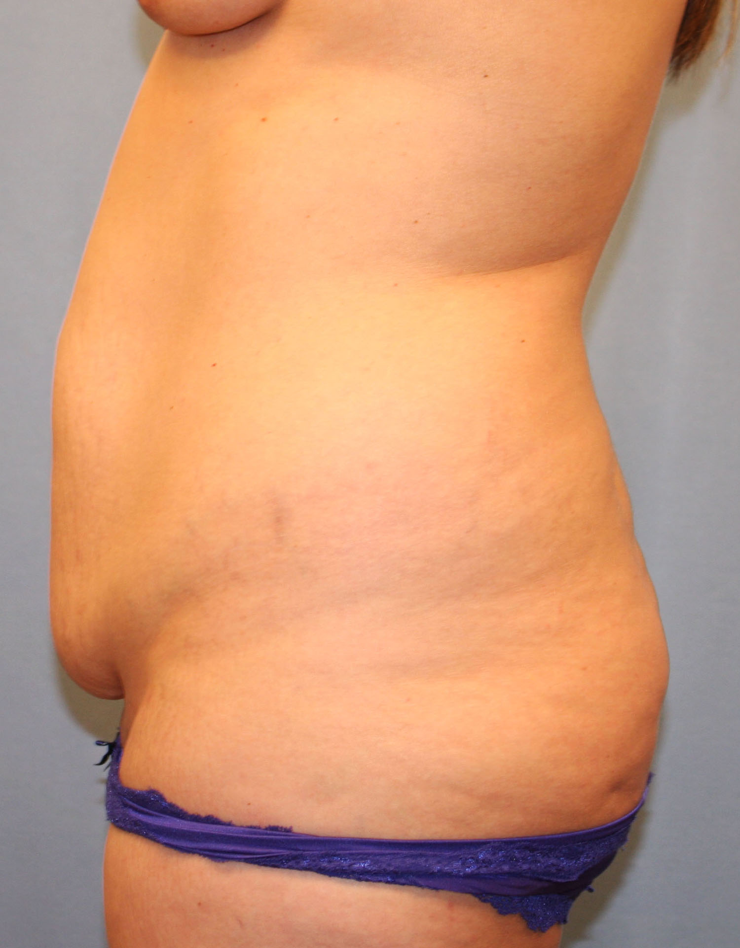 Before Image: Tummy Tuck - left-side