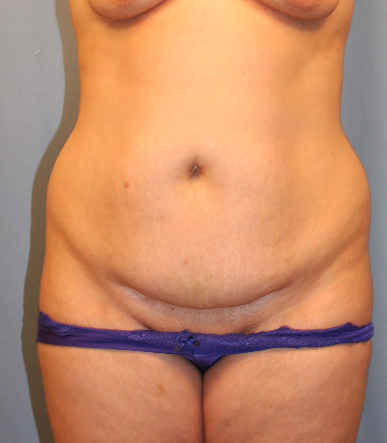 Before Image: Tummy Tuck - front