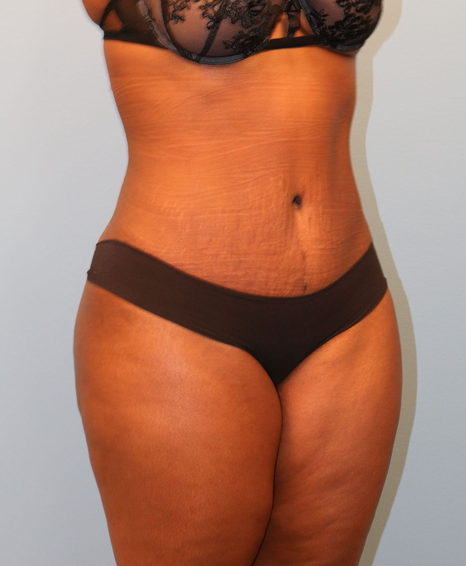 After Image: Tummy Tuck - right-front-oblique