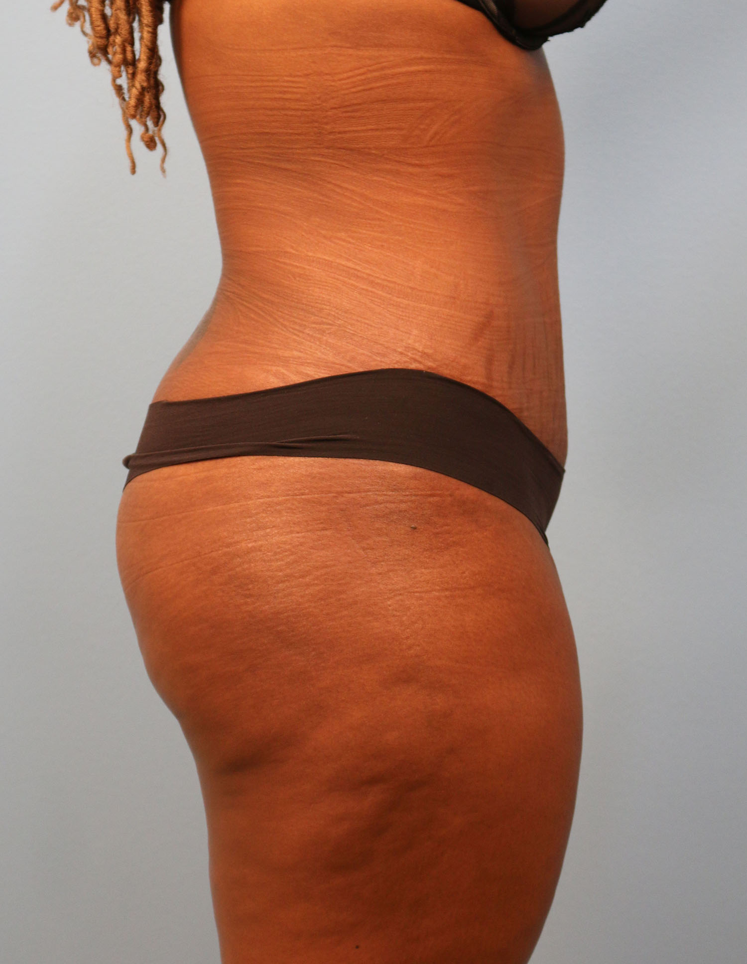 After Image: Tummy Tuck - right-side