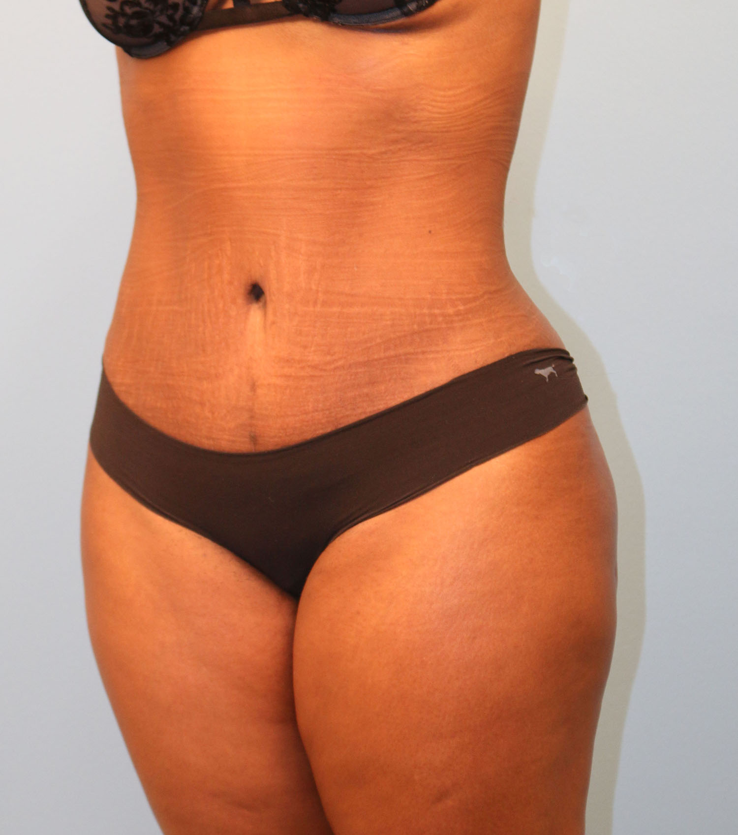 After Image: Tummy Tuck - left-front-oblique
