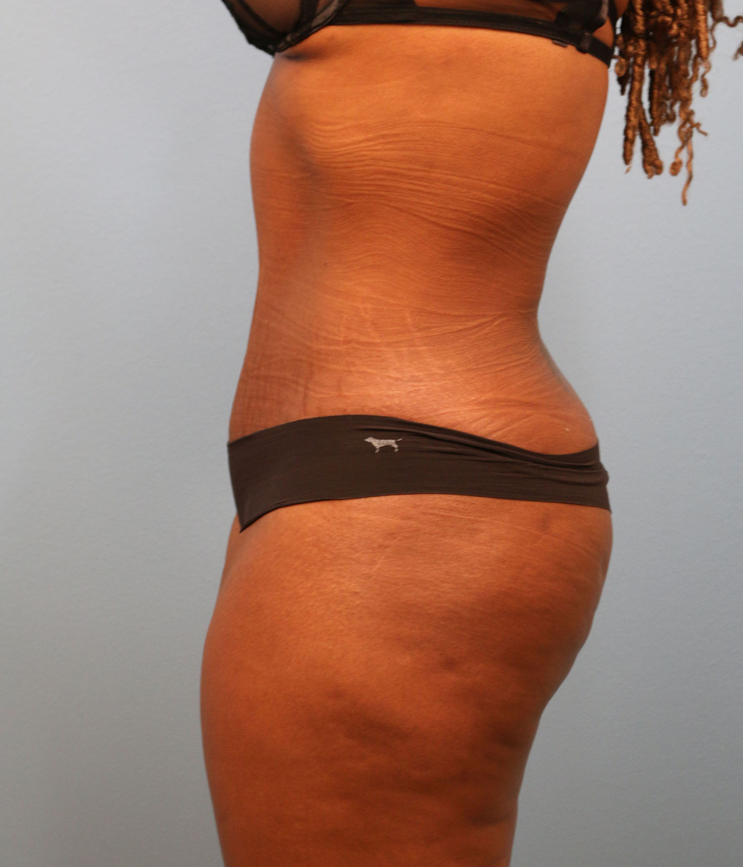 After Image: Tummy Tuck - left-side
