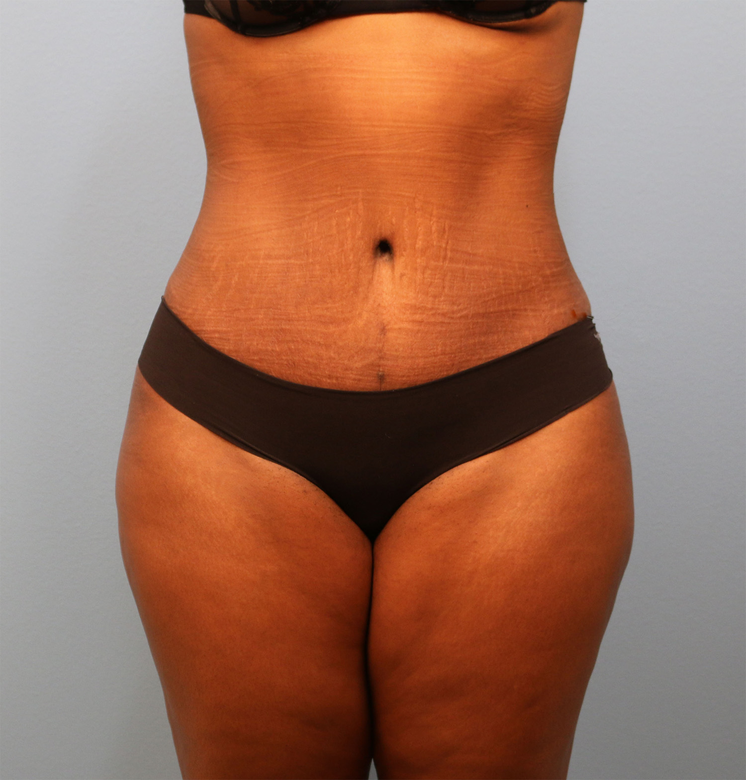 After Image: Tummy Tuck - front