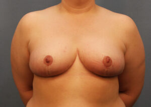 After Image: Breast Reduction
