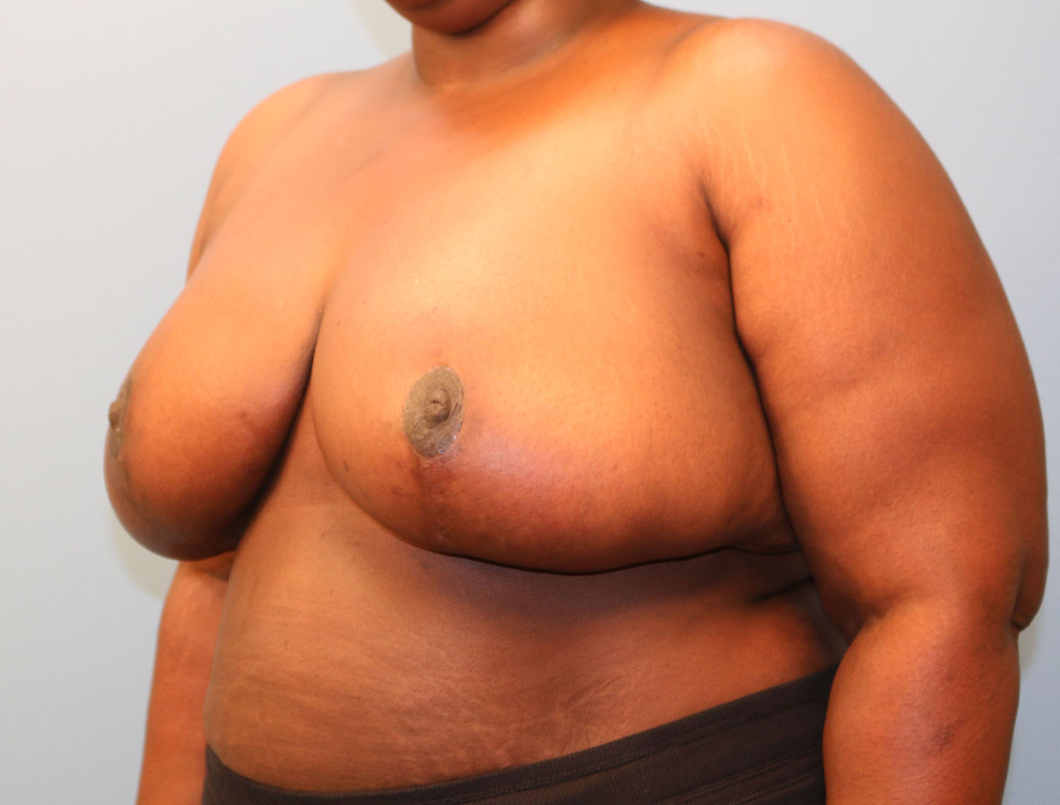 After Image: Breast Reduction - left-front-oblique