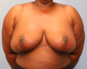 After Image: Breast Reduction