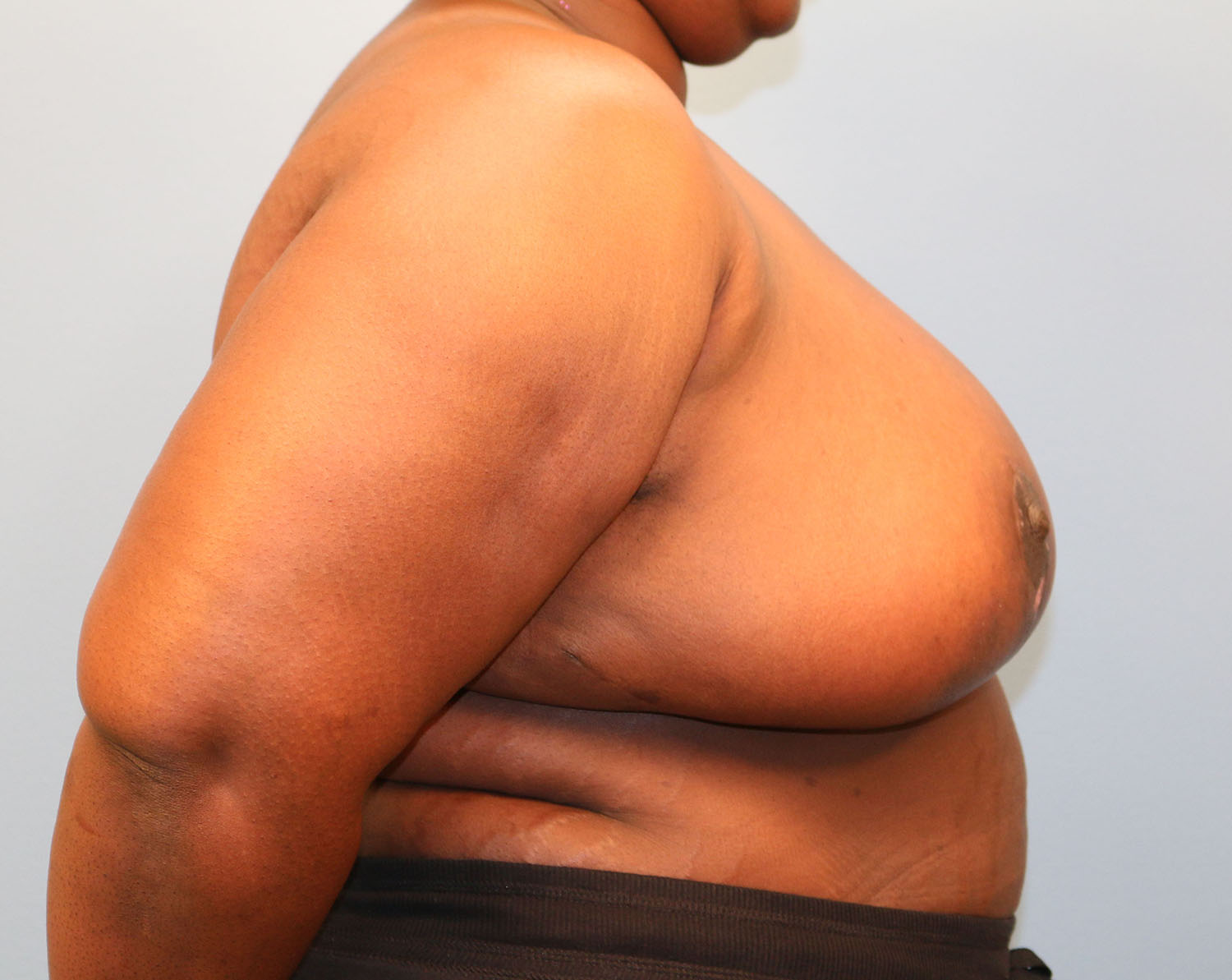 After Image: Breast Reduction - right-side