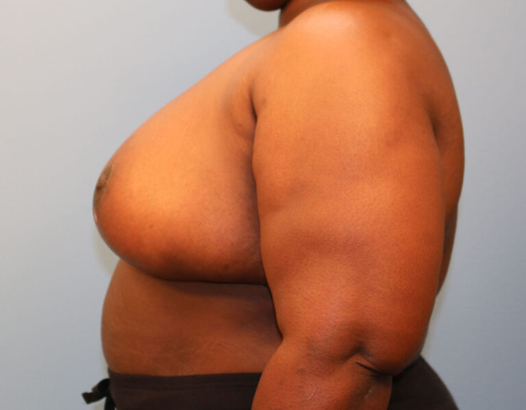 After Image: Breast Reduction - left-side