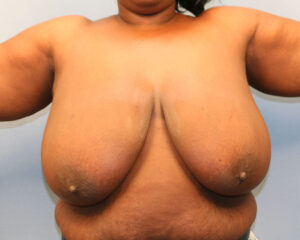 Before Image: Breast Reduction