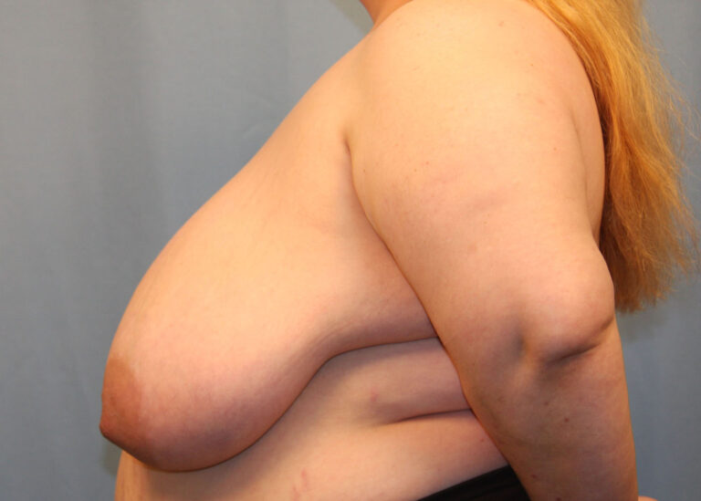 Before Image: Breast Reduction - left-side