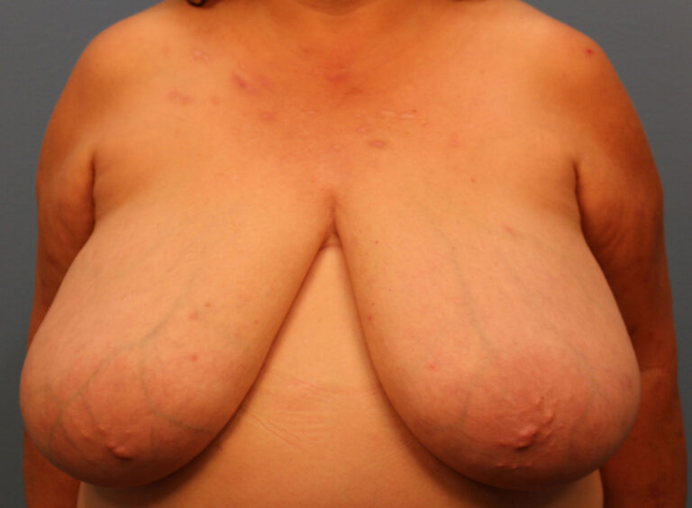 Before Image: Breast Reduction - front