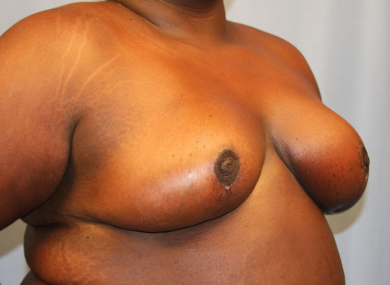 After Image: Breast Reduction - right-front-oblique