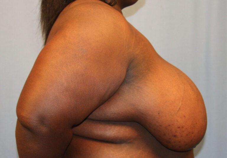 Before Image: Breast Reduction - right-side
