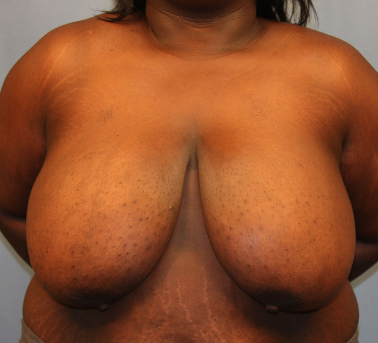 Before Image: Breast Reduction - front