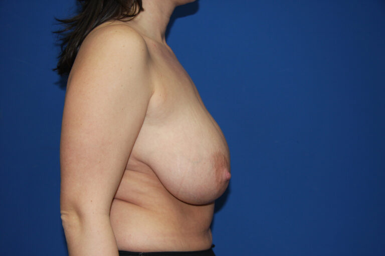 Before Image: Breast Reduction - right-side