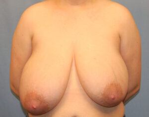 Before Image: Breast Lift