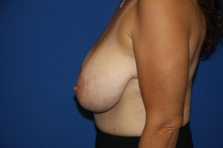 Before Image: Breast Lift - left-side