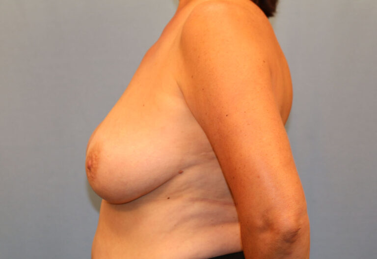Before Image: Breast Lift - left-side
