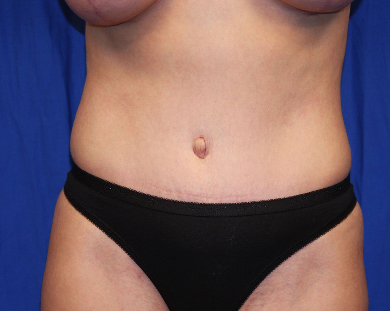 After Image: Tummy Tuck - front