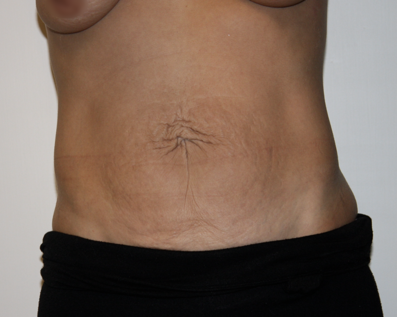 Before Image: Tummy Tuck - front