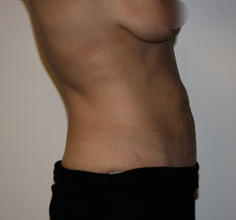 Before Image: Tummy Tuck - right-side
