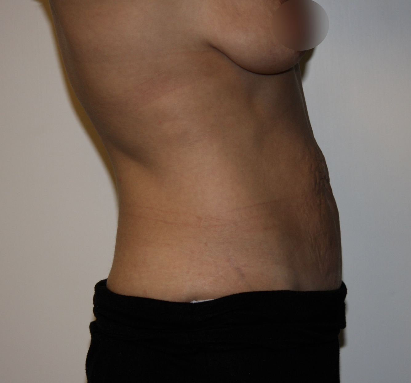 Before Image: Tummy Tuck - right-side