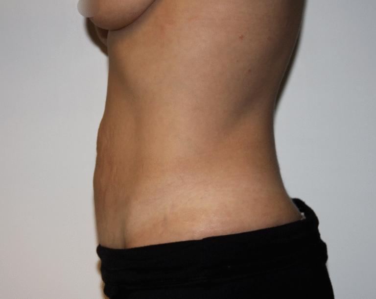 Before Image: Tummy Tuck - left-side