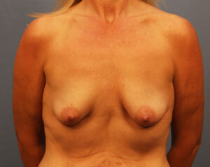 Before Image: Breast Lift