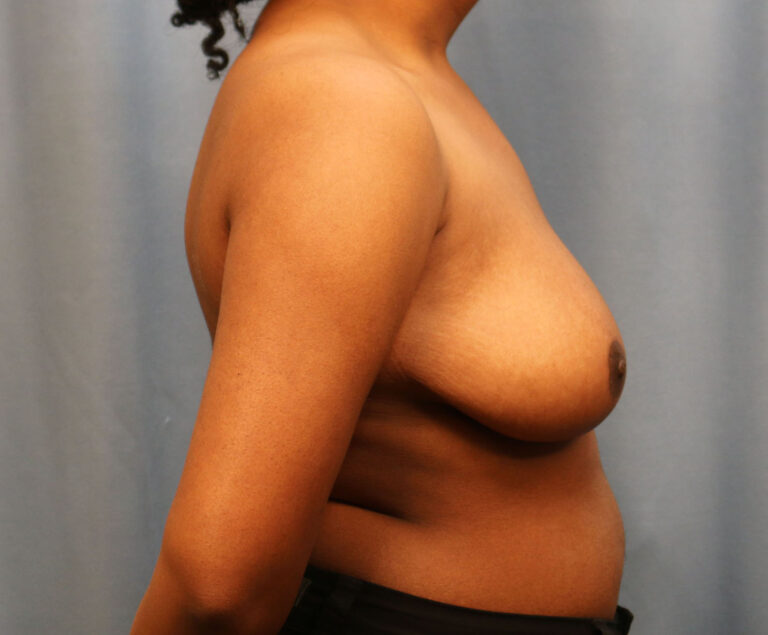 After Image: Breast Reduction - right-side