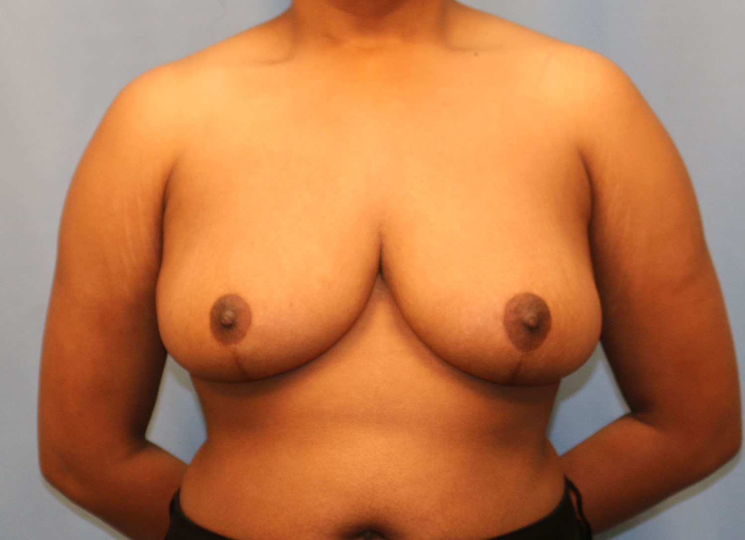 After Image: Breast Reduction - front
