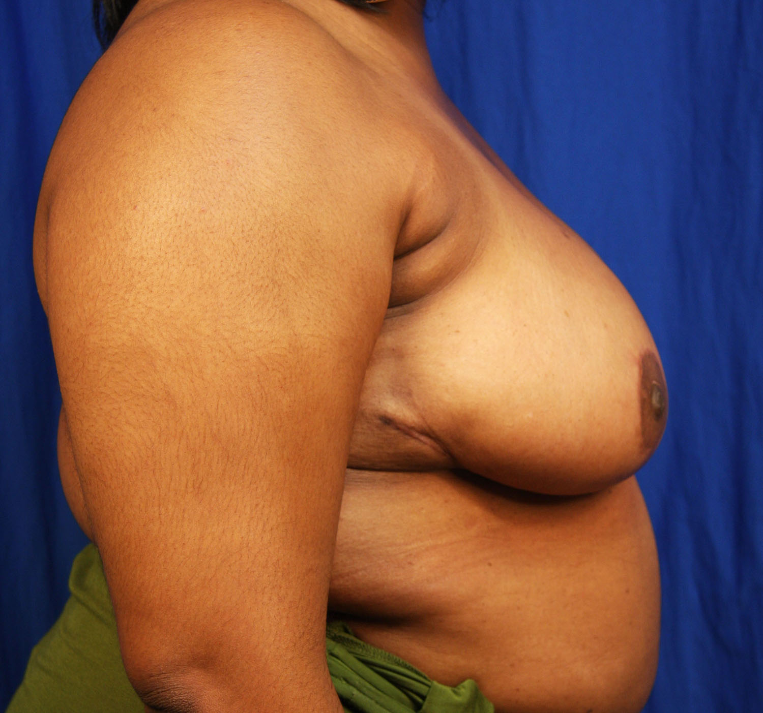 After Image: Breast Reduction - right-side