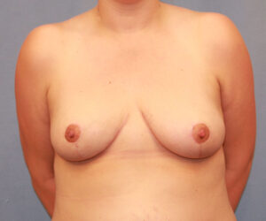 After Image: Breast Reduction