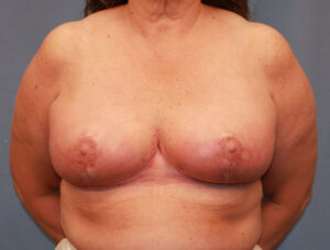 After Image: Breast Reduction