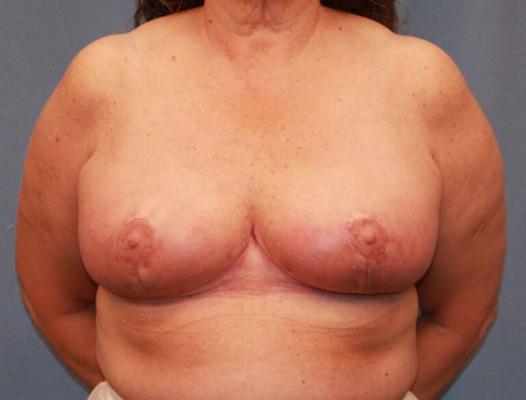 After Image: Breast Reduction - front