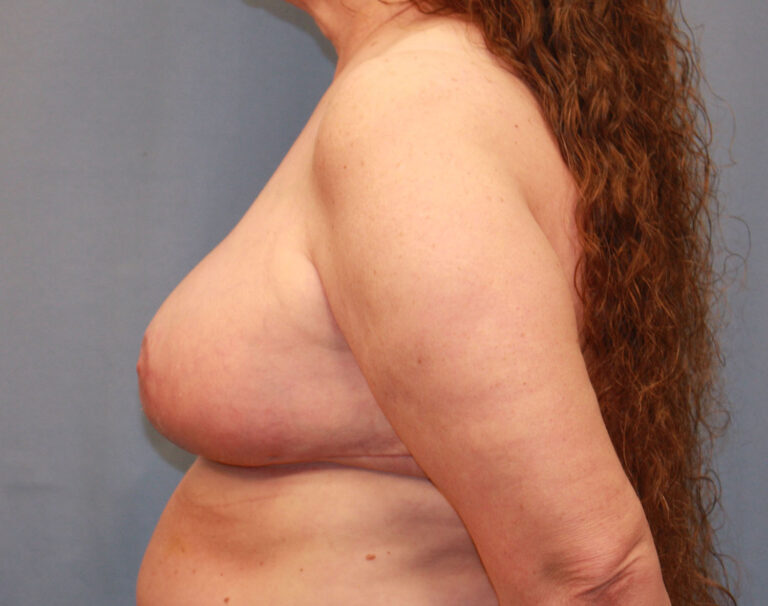 After Image: Breast Reduction - left-side