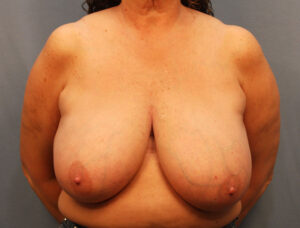 Before Image: Breast Reduction