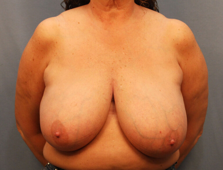 Before Image: Breast Reduction - front