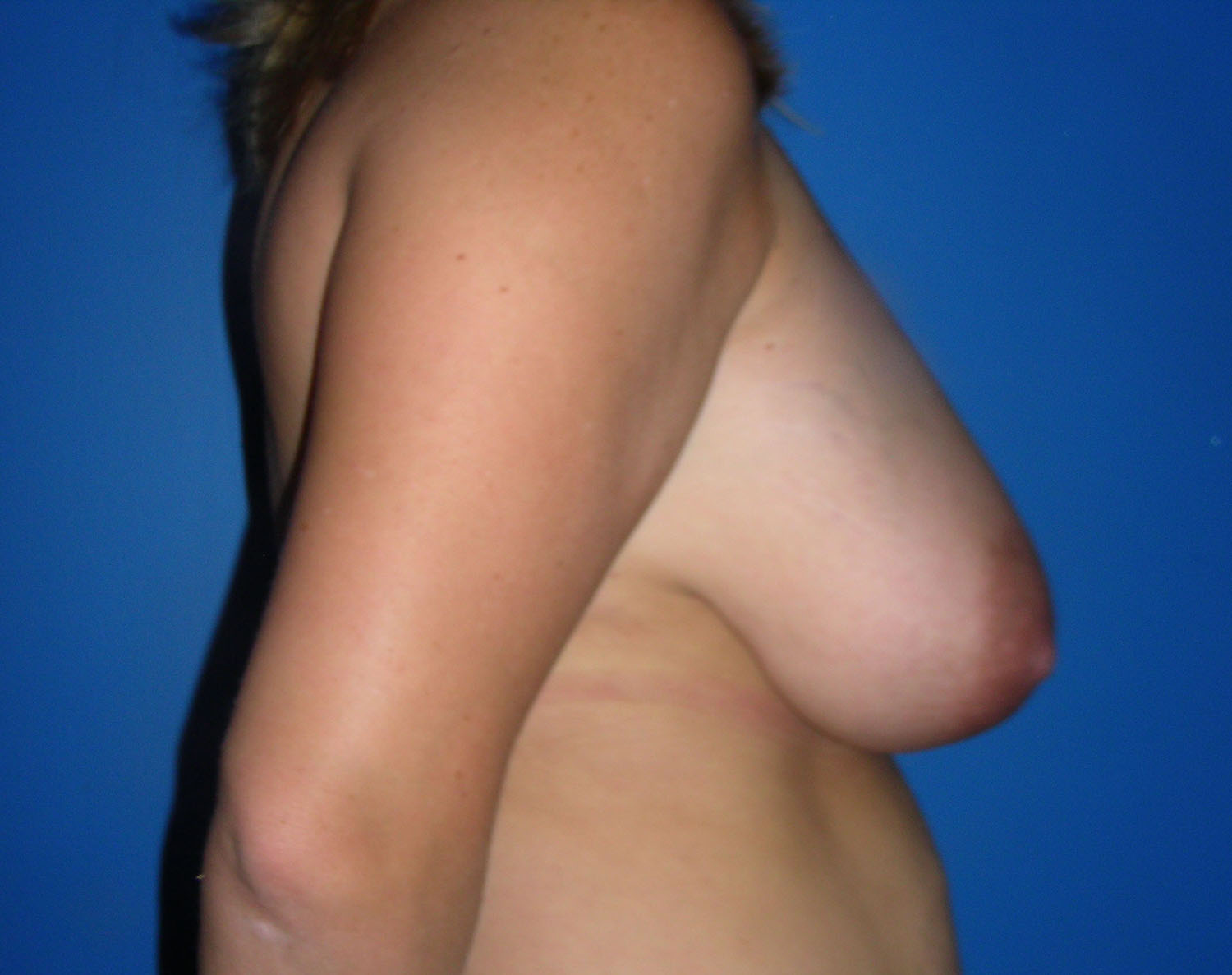 Before Image: Breast Reduction - right-side